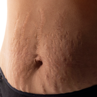 cara menghilangkan stretch mark